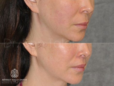Modified Upper Lip Lift - Right Side
