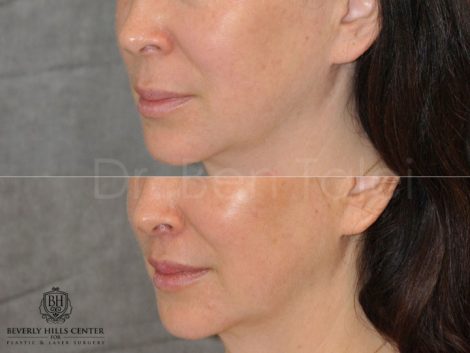 Modified Upper Lip Lift - Left Side