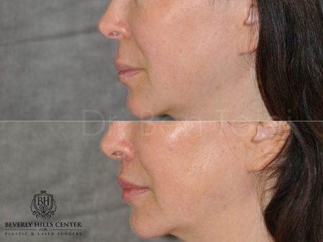 Modified Upper Lip Lift - Left Side