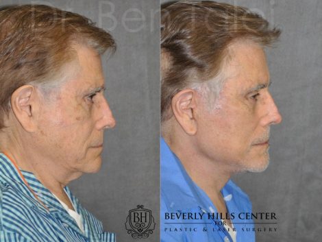 AuraLyft for Men - Right Side