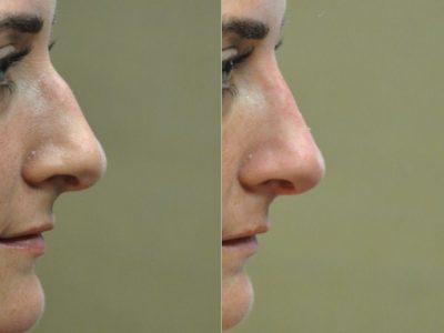 Non Surgical Rhinoplasty / Liquid Nosejob – Right Side