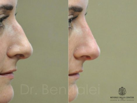 Non Surgical Rhinoplasty / Liquid Nosejob – Right Side