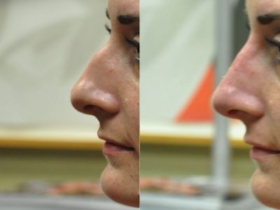 Non Surgical Rhinoplasty / Liquid Nosejob – Left Side