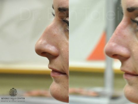 Non Surgical Rhinoplasty / Liquid Nosejoba - Left Side