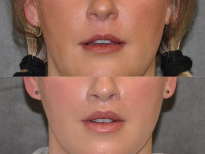 Upper Lip Lift Revision and Lower Lip V-Y Augmentation - Front