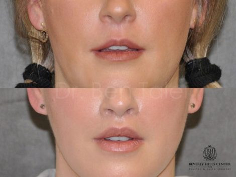 Upper Lip Lift Revision and Lower Lip V-Y Augmentation - Front