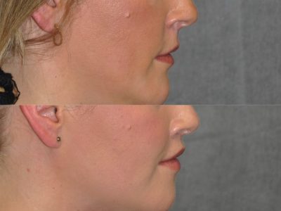 Upper Lip Lift Revision and Lower Lip V-Y Augmentation - Right Side