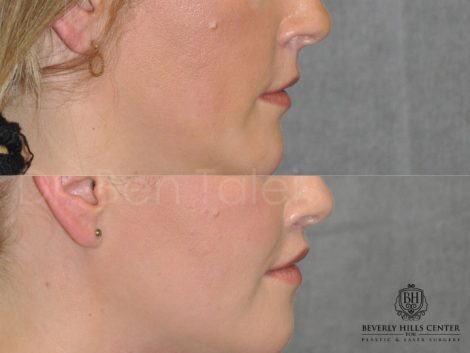 Upper Lip Lift Revision and Lower Lip V-Y Augmentation - Right Side