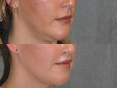 Upper Lip Lift Revision and Lower Lip V-Y Augmentation - Right Side