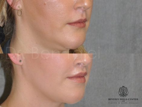 Upper Lip Lift Revision and Lower Lip V-Y Augmentation - Right Side