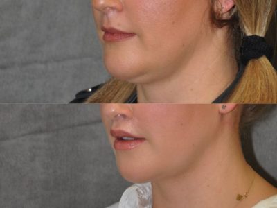 Upper Lip Lift Revision and Lower Lip V-Y Augmentation - Left Side