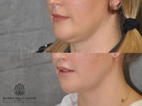 Upper Lip Lift Revision and Lower Lip V-Y Augmentation - Left Side