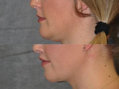 Upper Lip Lift Revision and Lower Lip V-Y Augmentation - Left Side