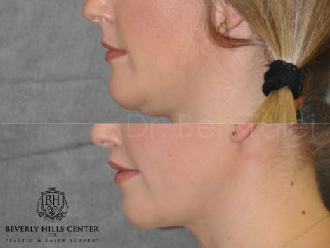 Upper Lip Lift Revision and Lower Lip V-Y Augmentation - Left Side