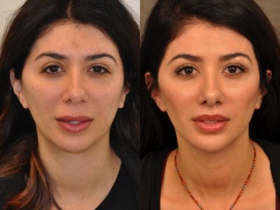 Modified Upper Lip Lift - Front