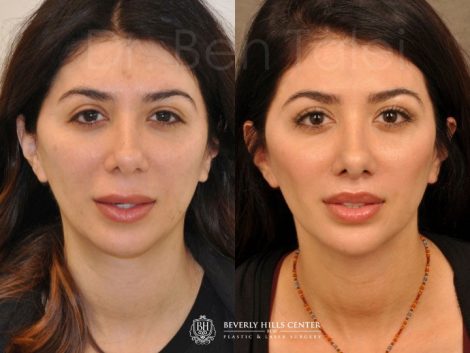 Modified Upper Lip Lift - Front