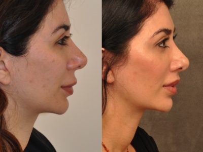 Modified Upper Lip Lift - Right Side