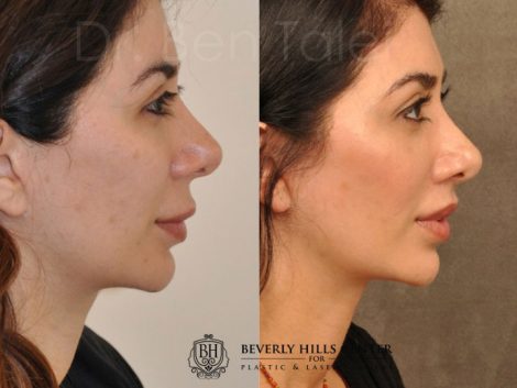 Modified Upper Lip Lift - Right Side