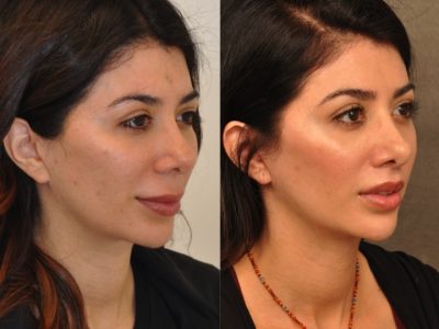 Modified Upper Lip Lift - Right Side