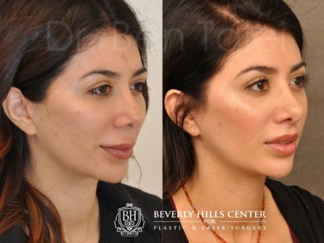 Modified Upper Lip Lift - Right Side