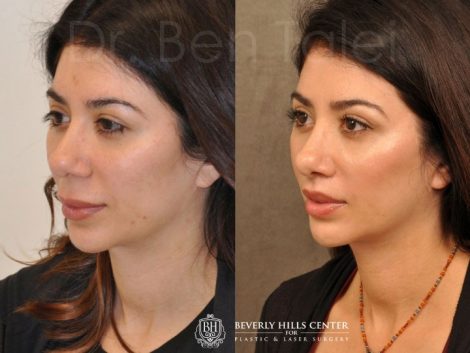 Modified Upper Lip Lift - Left Side