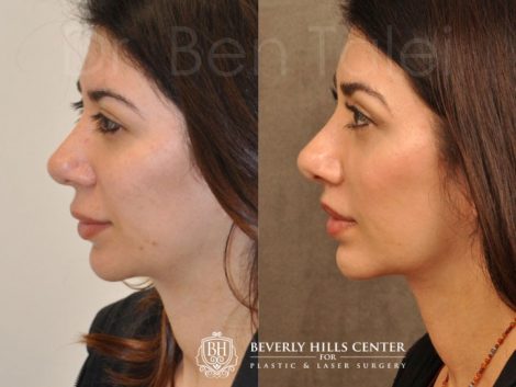 Modified Upper Lip Lift - Left Side