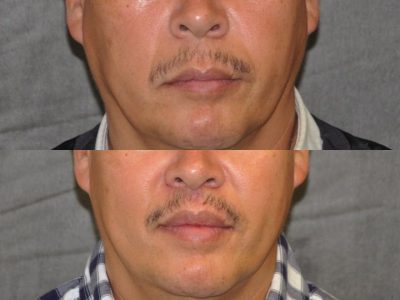 Modified Upper Lip Lift for Men - Front