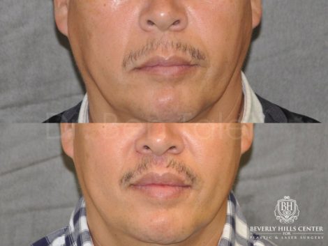 Modified Upper Lip Lift for Men - Front