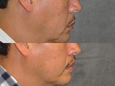 Modified Upper Lip Lift for Men - Right Side