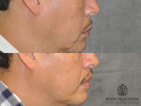 Modified Upper Lip Lift for Men - Right Side