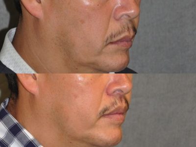 Modified Upper Lip Lift for Men - Right Side