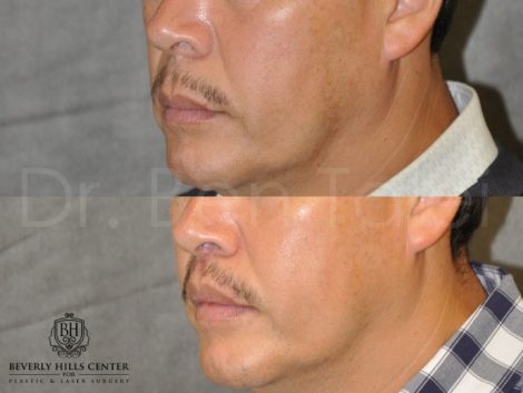 Modified Upper Lip Lift for Men - Left Side
