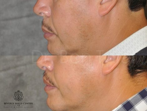 Modified Upper Lip Lift for Men - Left Side