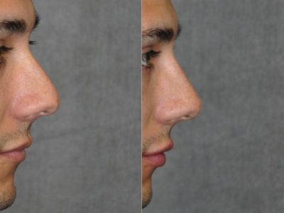 Non Surgical Rhinoplasty and Lip Filler - Right Side