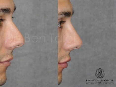Non Surgical Rhinoplasty and Lip Filler - Right Side