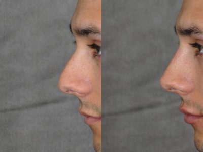 Non Surgical Rhinoplasty and Lip Filler - Left Side