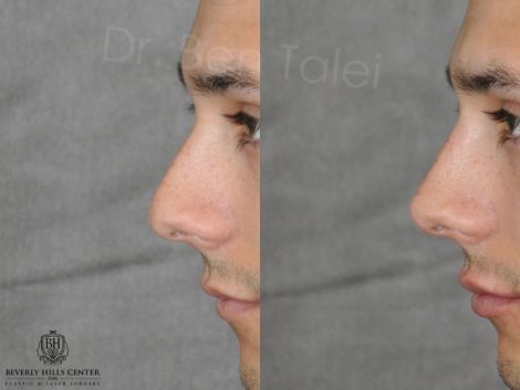 Non Surgical Rhinoplasty and Lip Filler - Left Side