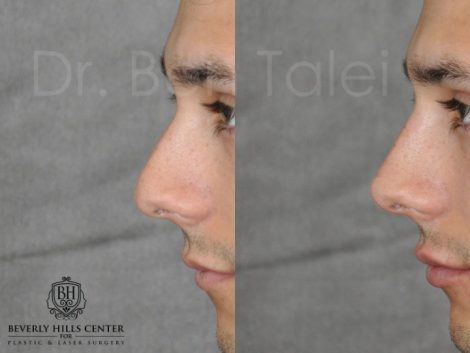 Non Surgical Rhinoplasty and Lip Filler - Left Side