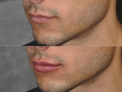 Non Surgical Rhinoplasty and Lip Filler - Left Side