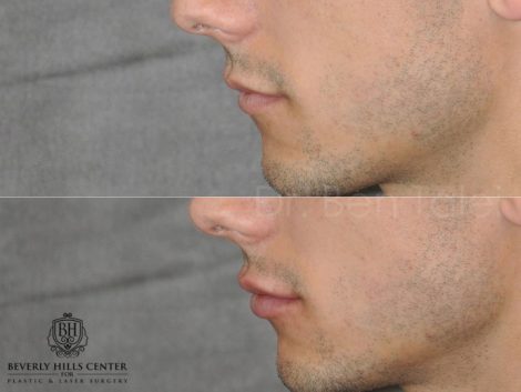 Beverly Hills Center Male Patient Before and After Non-surgical Rhinoplasty and Lip Filler