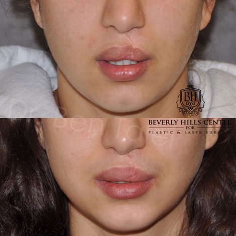 Beverly Hills Center Female Patient Before and After Cleft Lip Revision