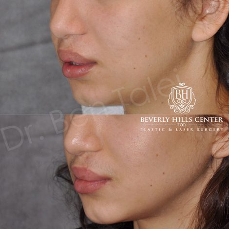 Beverly Hills Center Female Patient Before and After Cleft Lip Revision