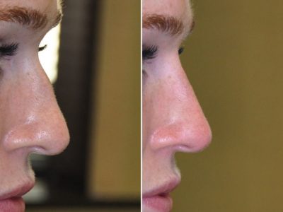 Non Surgical Rhinoplasty / Nosejob