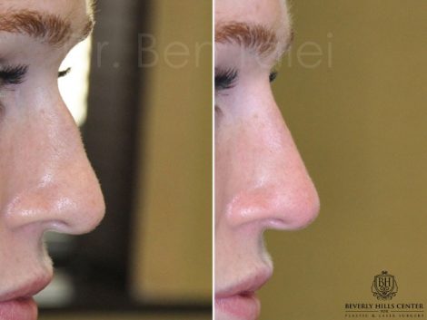 Non Surgical Rhinoplasty / Nosejob