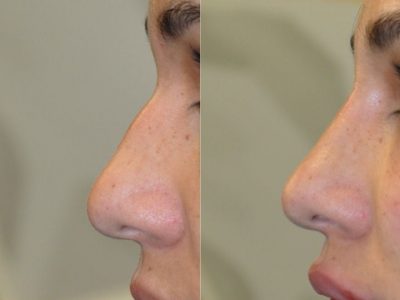 Non Surgical, Liquid Rhinoplasty / Nosejob