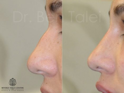 Non Surgical, Liquid Rhinoplasty / Nosejob