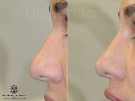 Non Surgical, Liquid Rhinoplasty / Nosejob