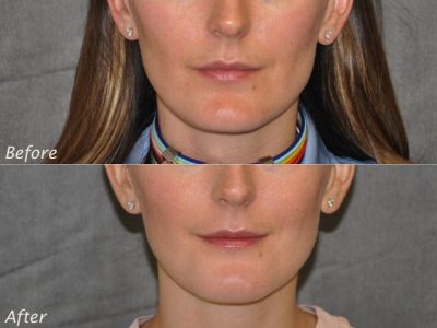 Internal Chin Reduction - Front