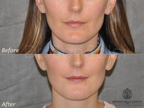Internal Chin Reduction - Front