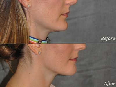 Internal Chin Reduction - Right Side